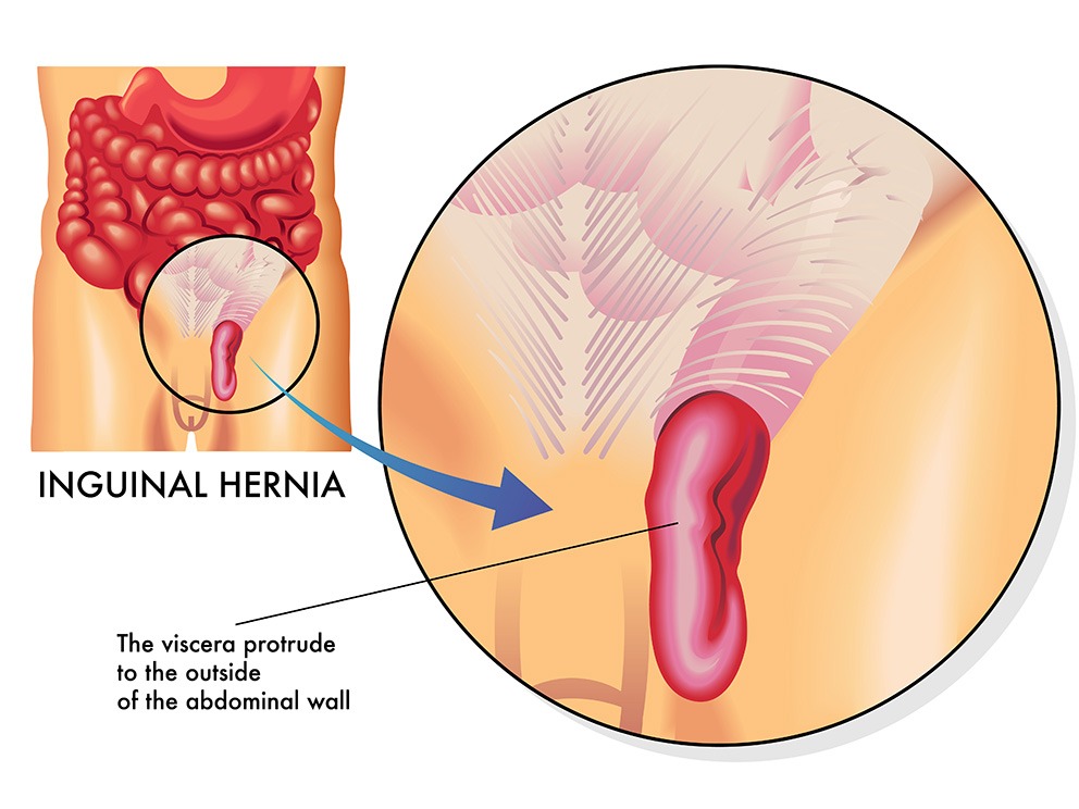 Inguinal Hernia Diagram