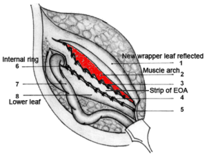 Desarda Technique Inguinal Hernia Diagram