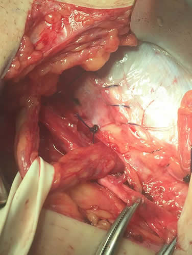 Reconstructed floor of inguinal canal without mesh
