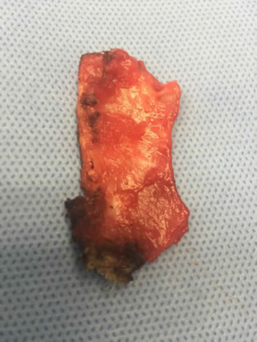 Section of Mesh removed from floor of inguinal canal