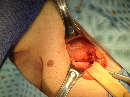 Hernia protruding from floor of inguinal canal