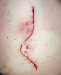 Ventral Hernia After Repair