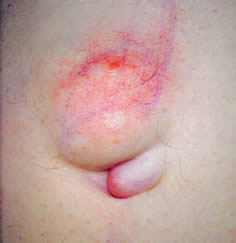 Ventral Hernia Before Repair